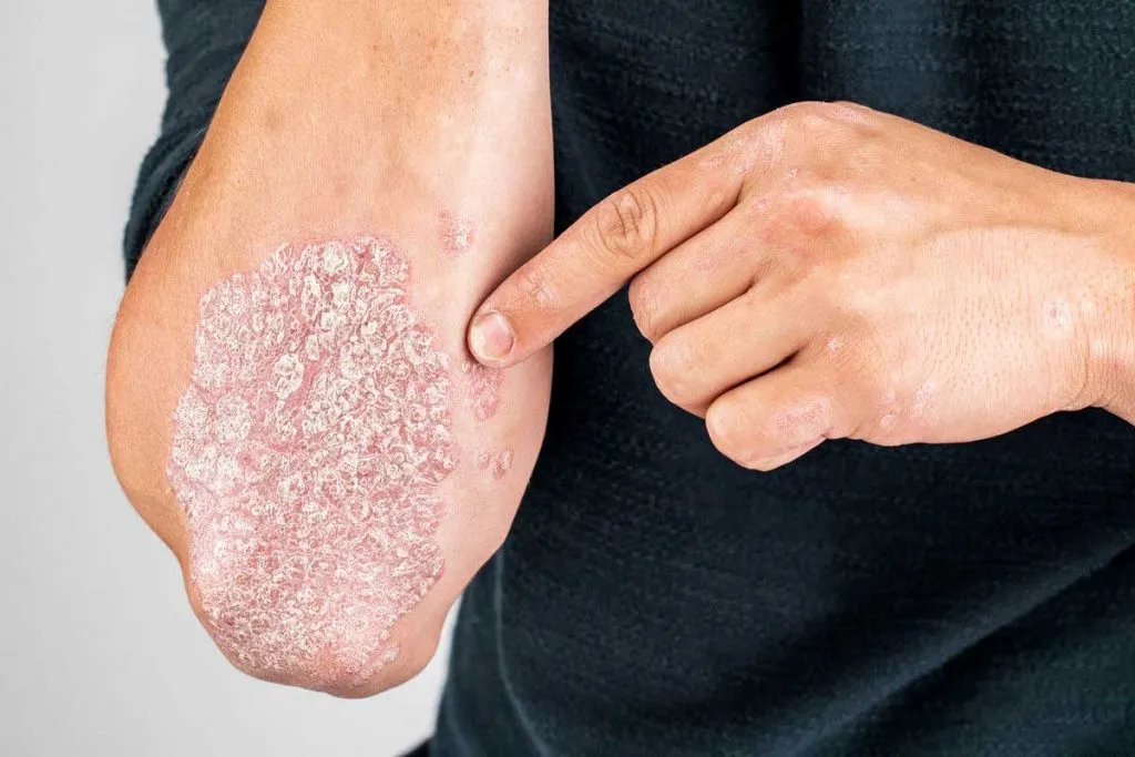 CBD for Psoriasis